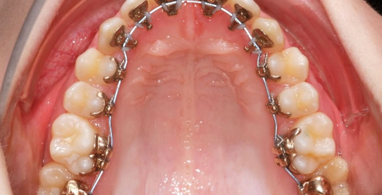Lingual tannregulering med brackets på innsiden av tennene